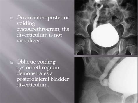 Micturating Cystourethrogram (MCU) .